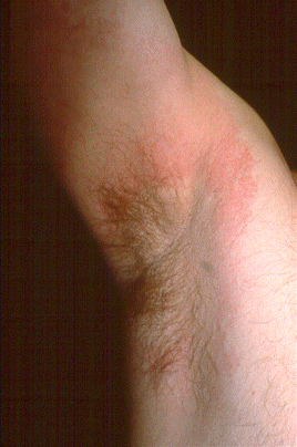 Clothing Dermatitis Clothing Dermatitis