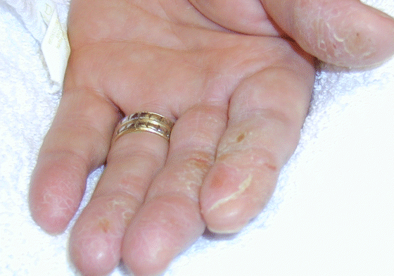 Optician - non-dominant hand dermatitis (allergy to ethyl acrylate) Optician - non-dominant hand dermatitis (allergy to ethyl acrylate)