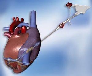 Cardioplegia Cannulae from Maquet
