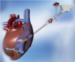 Cardioplegia Cannulae from Maquet