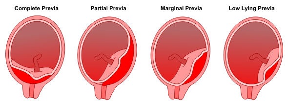 Accessory types and abnormal placentas
