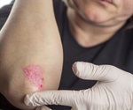 Abdominal fat emerges as independent risk factor for psoriasis in women