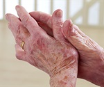 New study maps cellular fingerprints driving childhood arthritis