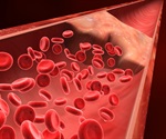 New and updated clinical practice guidelines released for treatment of pediatric venous thromboembolism