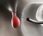 Differing views on virtual colonoscopy accuracy
