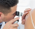 Bias found in AI models diagnosing skin diseases across demographics