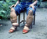 Anti-parasitic drug could accelerate the elimination of infection endemic to Africa