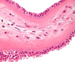 Study shows ADA2 is a sensitive, specific biomarker for macrophage activation syndrome