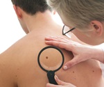 Genetically modified herpes virus shows promise against advanced melanoma