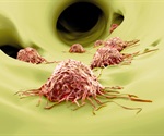 Key protein found to guide melanoma cells during spread