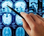 Unmasking the gender bias in Tourette syndrome diagnosis