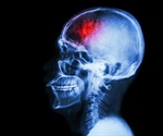 Research explores the link between lower micronutrient levels and chronic pain
