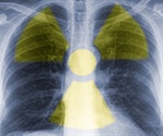 Radiotherapy drug used for treating rare neuroendocrine cancers can be safe, effective for patients