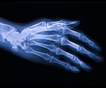 Spinning's positive impact on hip osteoarthritis uncovered