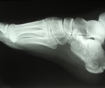 Risk for future fractures in postmenopausal women