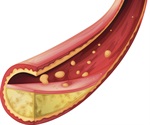 Study finds high rates of undiagnosed and untreated peripheral artery disease
