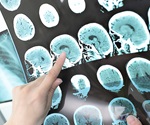Edoxaban proves effective in preventing blood clots, stroke after heart valve surgery