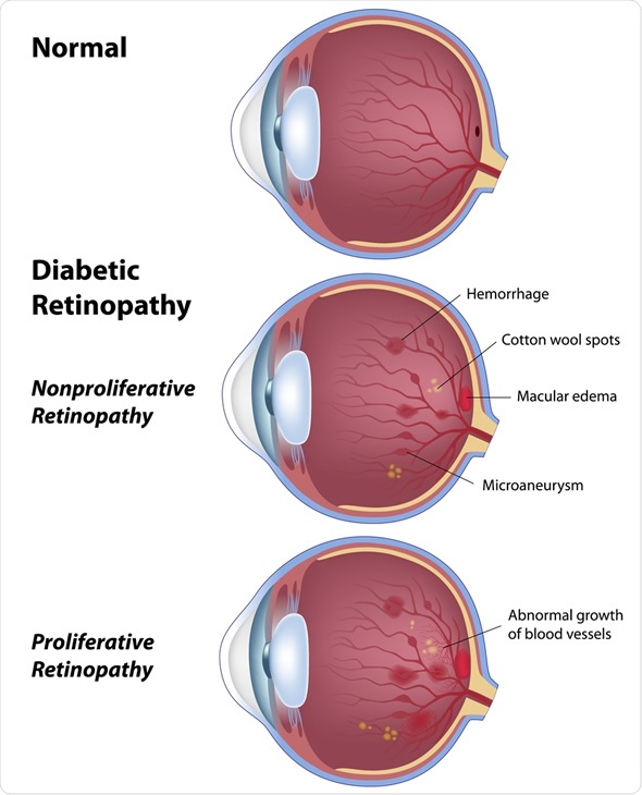 Diabetic retinopathy Diabetic retinopathy