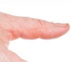 Koilonychia (Spoon Nails)