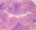 Acute Appendicitis Overview