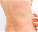 Hives in Babies
