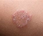 Ringworm Prevention