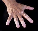 Types of Genodermatoses