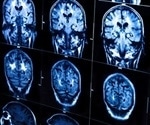 Home-based brain stimulation system uses AI to enhance concentration