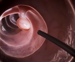 CT colonography lacks the sensitivity of conventional colonoscopy