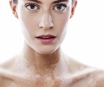 Skin Pigmentation Disorders: An Overview