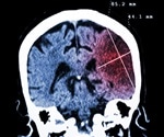 Counseling eases the depression of people caring for a loved one with the devastating brain disease