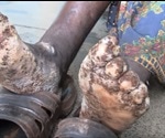 Tungiasis Symptoms and Diagnosis