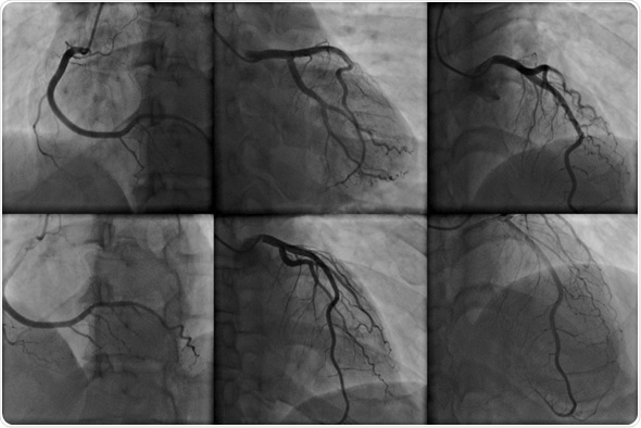 Coronary angiography - Image Copyright: kalewa / Shutterstock