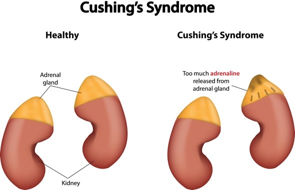 Cushing