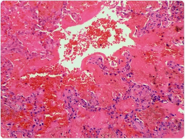 Goodpastures syndrome is a rare autoimmune disease in which antibodies attack the lungs and kidneys. Bleeding lung tissue is shown here. Magnification 200x - Image Copyright: Jubal Harshaw / Shutterstock