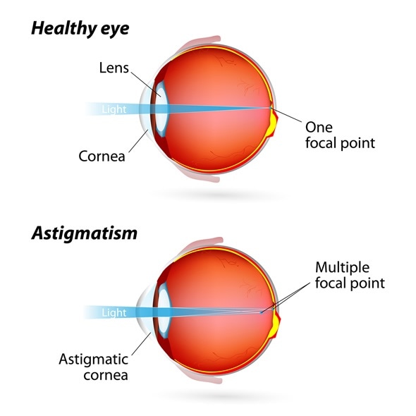 Astigmatism. Eye Condition - Image Copyright: Designua / Shutterstock Astigmatism. Eye Condition - Image Copyright: Designua / Shutterstock