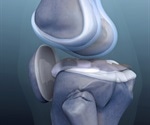 Earlier ACL surgery may reduce risk of knee osteoarthritis