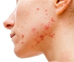 Study examines how often acne recurs after isotretinoin treatment