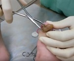 Onychogryphosis - Ram's Horn Nails
