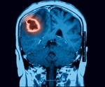 Causes of Intracerebral hemorrhage (ICH)