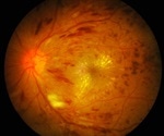 Exonate plans 'CLEAR-DE' Phase IIb clinical trial of lead candidate EXN407 for diabetic eye disease