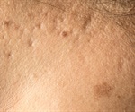 Carbon dioxide laser could be the fix for photoaging or skin damaged by the sun