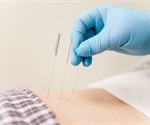 Electroacupuncture may aid in personalized ribavirin dosing for long COVID