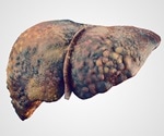 Waist-to-height ratio found to predict liver damage better than BMI