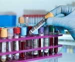 At-home saliva test to diagnose adrenal insufficiency makes a difference to patients' health