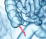 Appendix removed through a patient's vagina