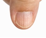 Potential Causes of Longitudinal Ridging