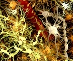 Combined Imaging and Theranostic Nanoparticles for Neurological Diseases