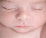 Milia in Babies