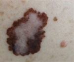 Cutaneous Manifestations of Internal Malignancy